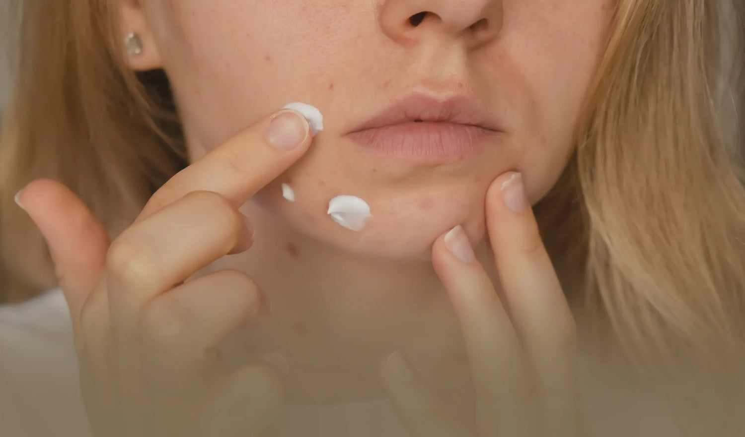 Acretin Cream: The Effective Solution for Treating Acne