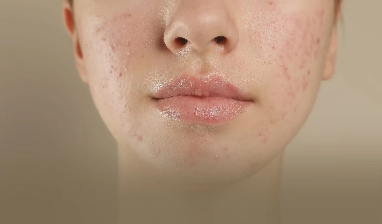 Everything You Need to Know About Roaccutane for Acne