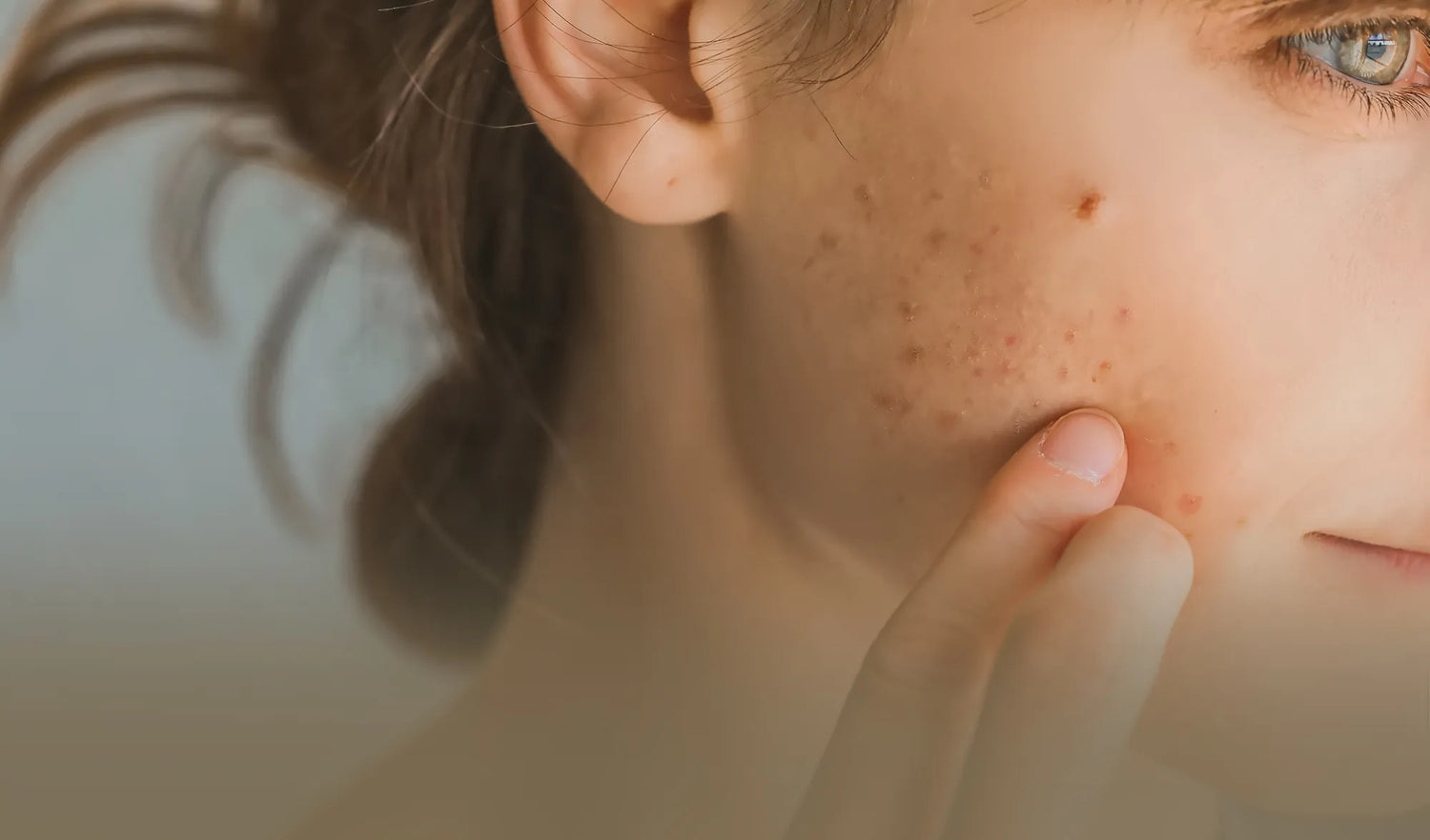 Real Experiences with Roaccutane and Expected Results